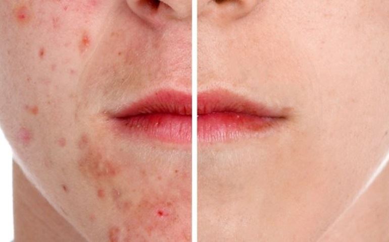 ACNE: TUDO O QUE VOCÊ PRECISA SABER