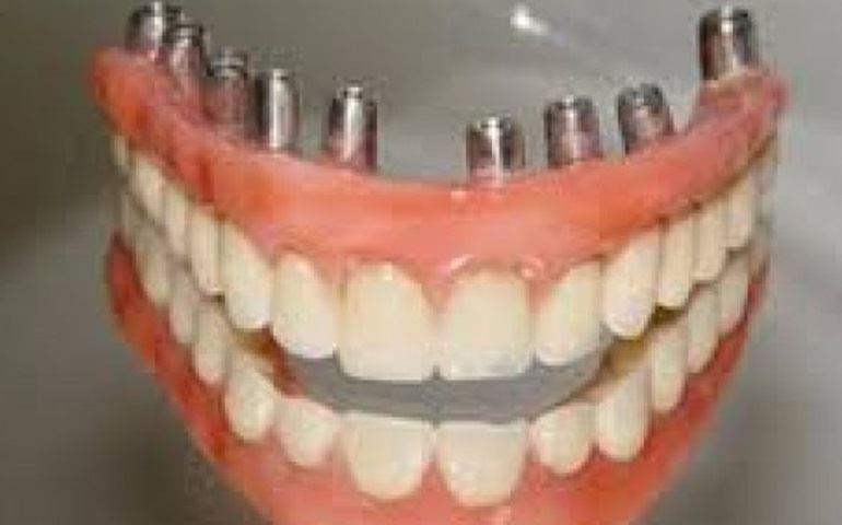 *ALERTA! Algumas clínicas dentárias estão usando protocolos (prótese) de má qualidade.