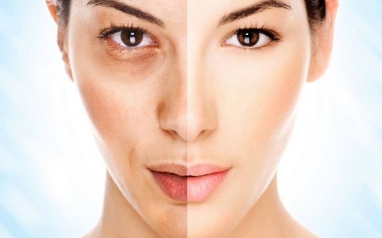 O Melasma agora tem os dias contados: Novo tratamento chega ao Brasil