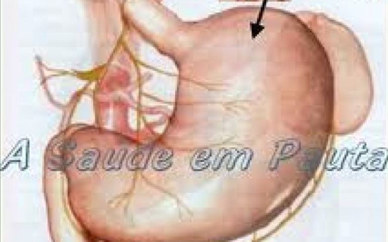 QUEM OPEROU DO ESTÔMAGO TERÁ 50% DE DESCONTO EM RESTAURNTES.